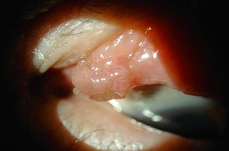 Fig. 27.11, Squamous papilloma: an exophytic tarsal lesion.