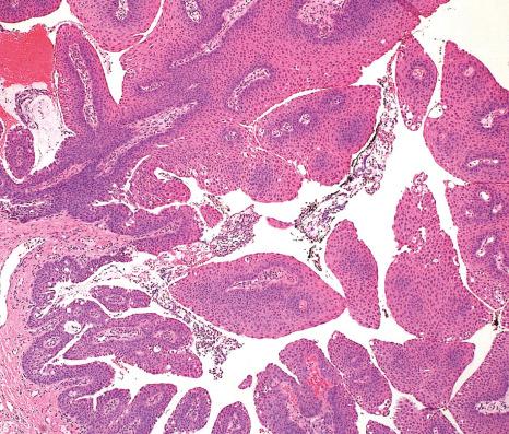 Fig. 27.12, Squamous papilloma: histology shows fronds of nonkeratinized squamous epithelium surrounding central fibrovascular cores.