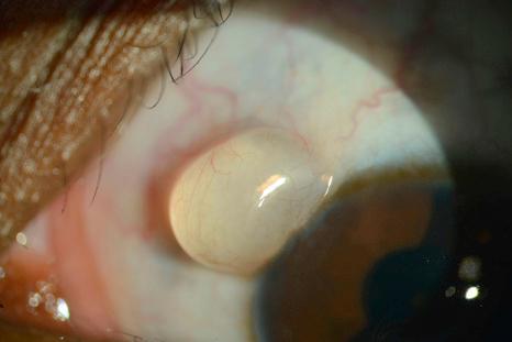 Fig. 27.15, Epithelial cyst: clinical appearance of a cyst adjacent to the limbus.