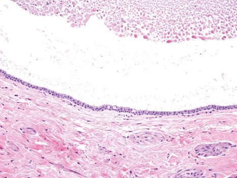 Fig. 27.16, Epithelial cyst: histology shows a cystic space filled with epithelial debris and lined by two layers of cuboidal epithelium with rare goblet cells.