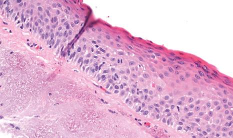 Fig. 27.17, Actinic keratosis: histology shows acanthotic epithelium with surface keratinization and mild cytological atypia with increased mitotic activity. Actinic elastotic degeneration is present in the substantia propria.