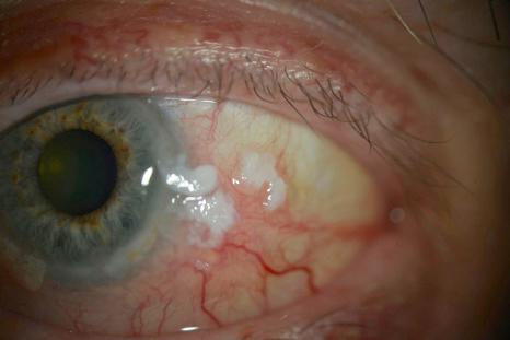 Fig. 27.18, Ocular surface squamous neoplasia (OSSN): there is a flat leukoplakic and slightly erythematous bulbar conjunctival lesion adjacent to the temporal (9 o'clock) limbus of a left eye. Dilated feeding vessels are seen.