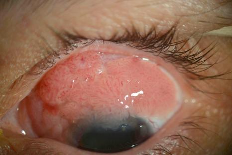 Fig. 27.19, Ocular surface squamous neoplasia (OSSN): a large, fleshy papillomatous lesion extends over the superior bulbar conjunctiva at the limbus and extends onto the cornea.