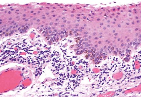 Fig. 27.2, Normal limbus: histology shows nonkeratinizing squamous epithelium and palisades of Vogt with melanin pigmentation of the basal epithelium and scattered intraepithelial dendritic melanocytes.