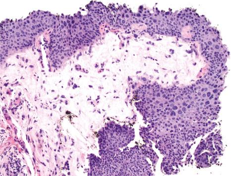 Fig. 27.23, Ocular surface squamous neoplasia (OSSN), carcinoma in situ: histology shows full-thickness dysplasia. There is marked cytological atypia with nuclear enlargement, pleomorphism, and hyperchromasia.