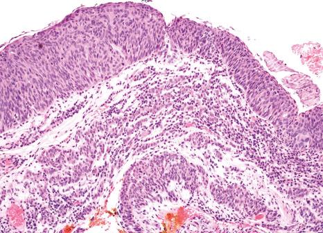 Fig. 27.24, Squamous cell carcinoma: histology shows invasion of the conjunctiva substantia propria by nests and cords of poorly differentiated tumor cells. No significant keratinization is seen.