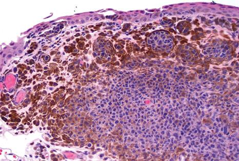 Fig. 27.29, Compound nevus: junctional nests and involvement of the substantia propria is evident.