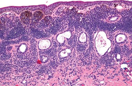 Fig. 27.30, Subepithelial nevus: nevus cells are present in the substantia propria without junctional nests. Epithelial cysts are present within the lesion. Note how there is increased melanin pigmentation of the superficial nevus cells compared to those toward the base.