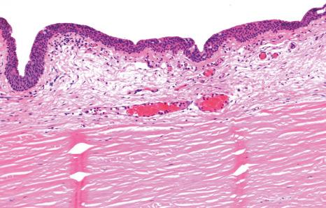 Fig. 27.3, Normal bulbar conjunctiva: histology shows squamous mucosa with scattered goblet cells and loose connective tissue in the substantia propria.