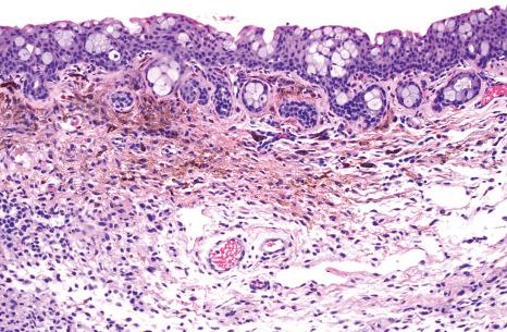 Fig. 27.31, Combined nevus: histology shows nests of common nevus cells and more pigmented spindle and dendritic cells.