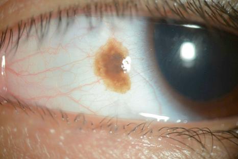 Fig. 27.32, Inflamed juvenile nevus: partially pigmented inflamed juvenile nevus on the bulbar conjunctiva at 9 o'clock. Intralesional cysts are seen.