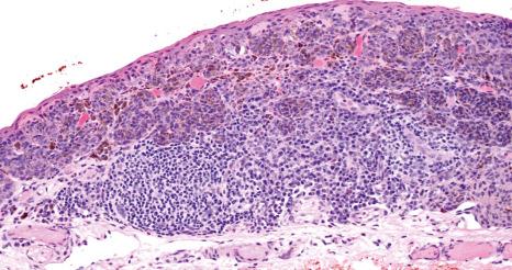 Fig. 27.33, Inflamed juvenile nevus: nests of nevus cells are admixed with lymphocytes and plasma cells.