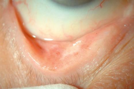 Fig. 27.36, Primary acquired melanosis (PAM): clinical view of PAM on the lower tarsal conjunctiva that appears like sprinkled cinnamon.