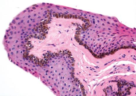 Fig. 27.37, Primary acquired melanosis (PAM) without atypia: there is uniform pigmentation of the basal layer of the epithelium without melanocyte atypia.