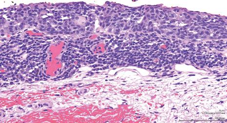 Fig. 27.39, Primary acquired melanosis (PAM) with atypia: atypical melanocytes almost completely replace the epithelium in this area. This degree of involvement could be considered by some pathologists as melanoma in situ. A bandlike chronic inflammatory infiltrate is present at the base.