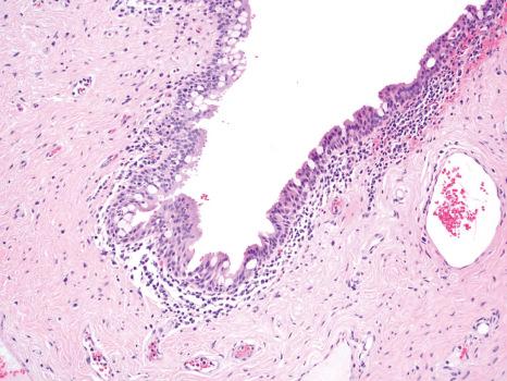 Fig. 27.4, Normal fornix: histology shows pseudostratified columnar epithelium with numerous goblet cells and lymphocytes and plasma cells in the substantia propria.