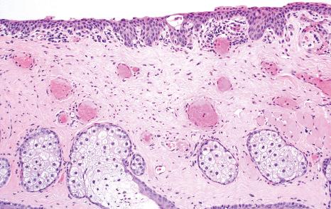 Fig. 27.5, Normal palpebral (tarsal) conjunctiva: histology shows squamous mucosa tightly adherent to the tarsus, which contains sebaceous glands, called Meibomian glands.