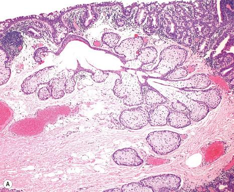 Fig. 27.9, Complex choristoma: ( A ) one area of the lesion contained dermal type collagen and adipose tissue with skin appendages (sebaceous glands). ( B ) In a different area of the lesion, lacrimal gland tissue was identified.