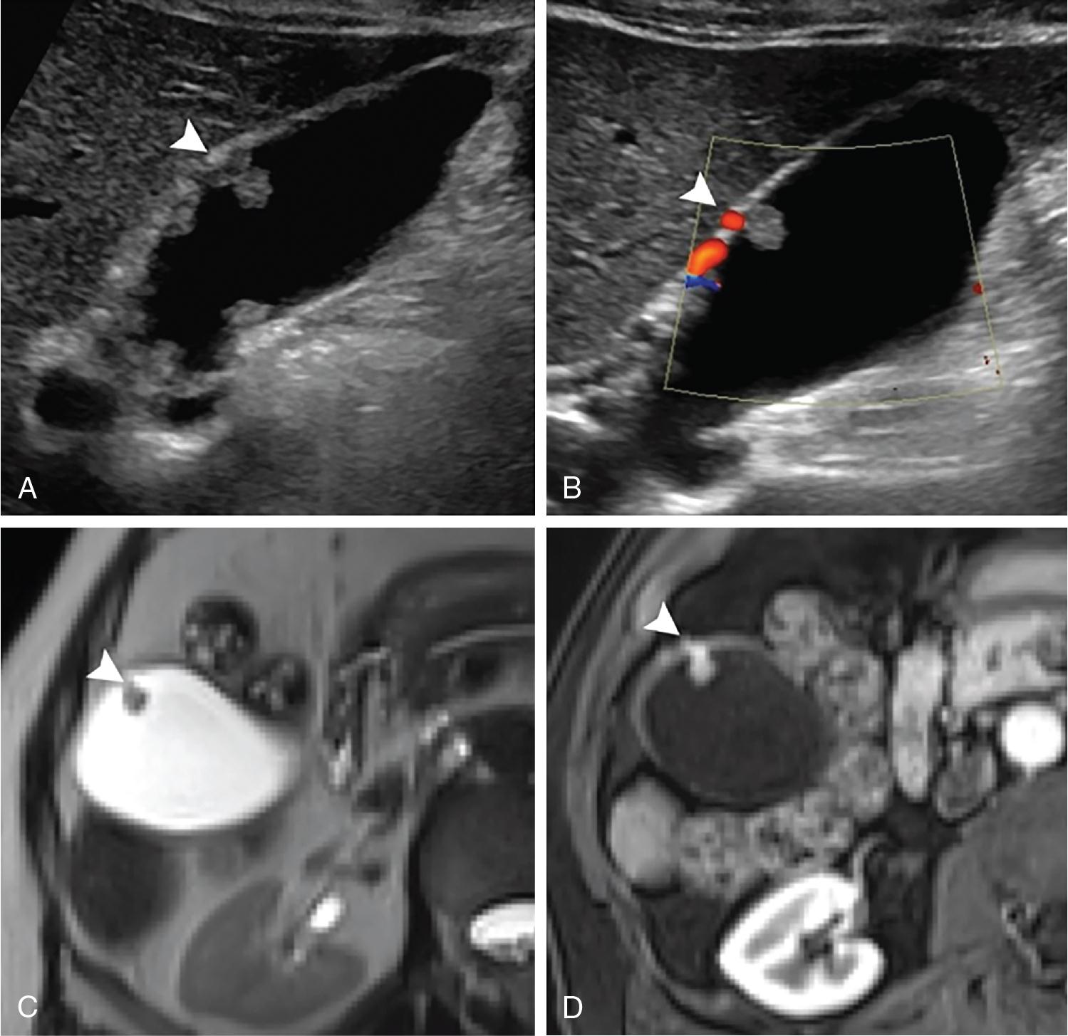 FIGURE 49.1, Radiographic appearance of cholesterol polyp.