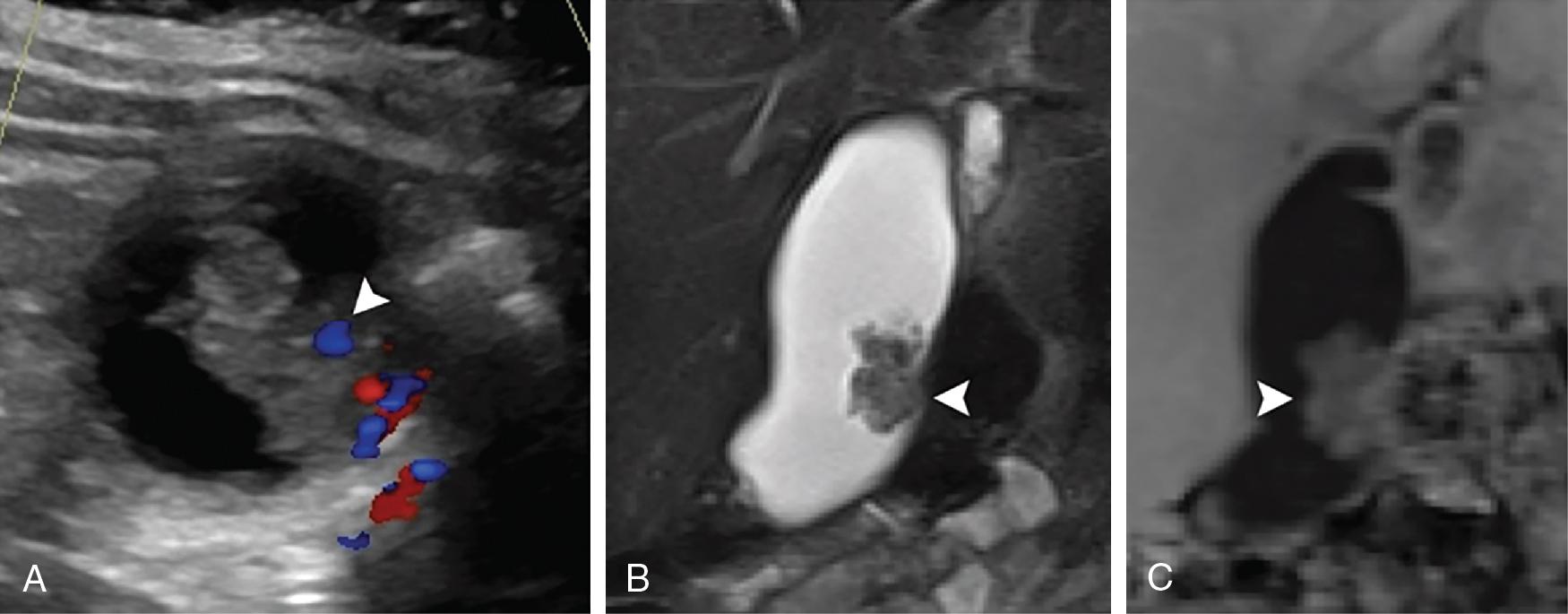 FIGURE 49.2, Radiographic appearance of gallbladder adenoma.