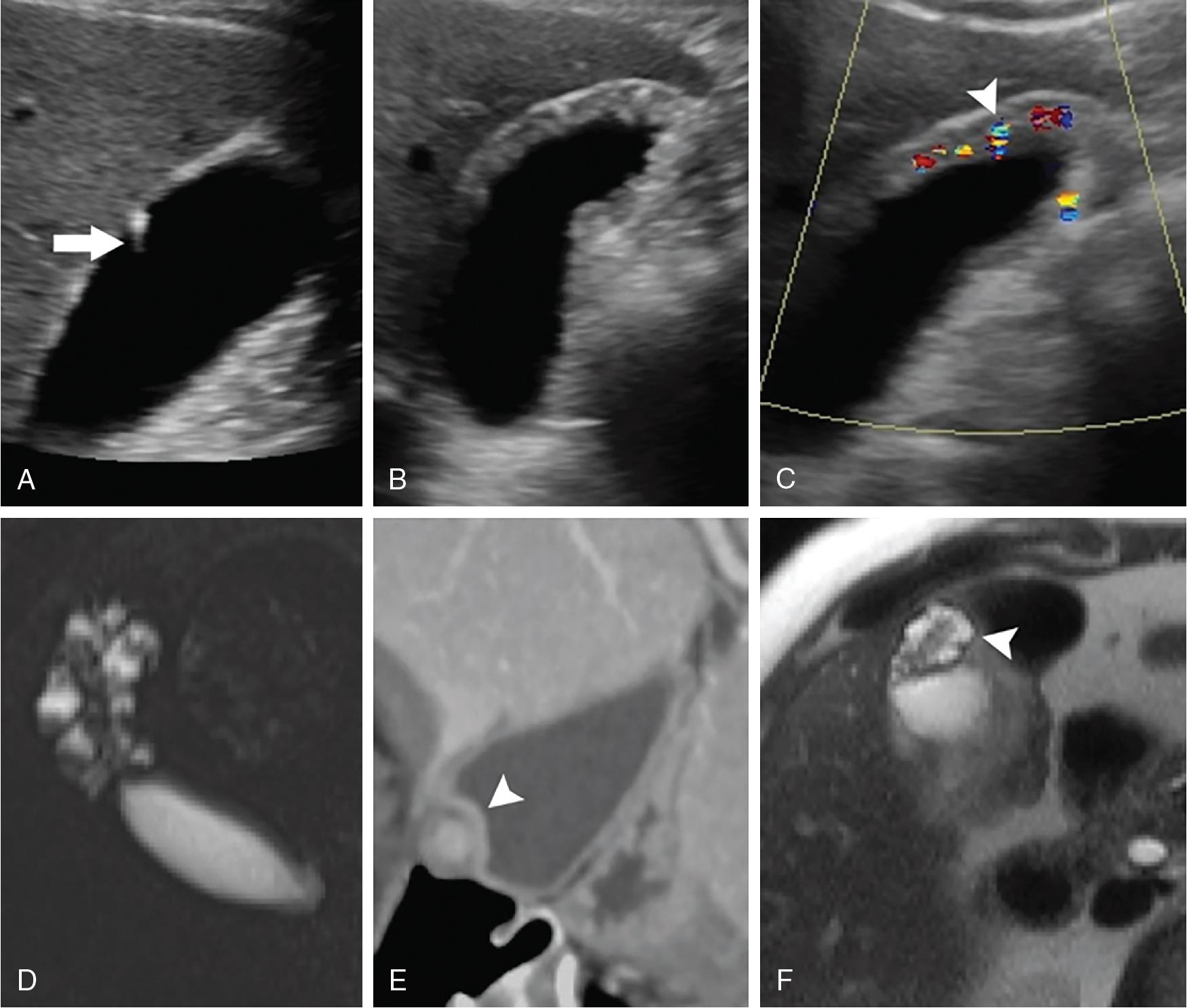 FIGURE 49.3, Radiographic appearance of adenomyomatosis.