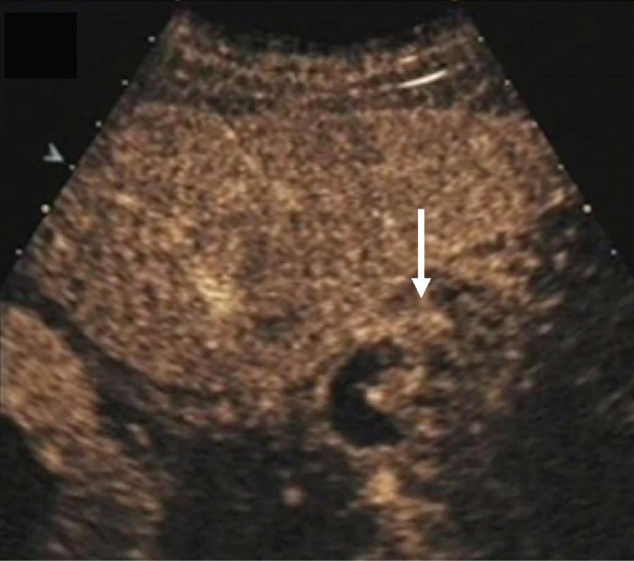 FIGURE 49.4, Contrast-enhanced ultrasound of gallbladder carcinoma.