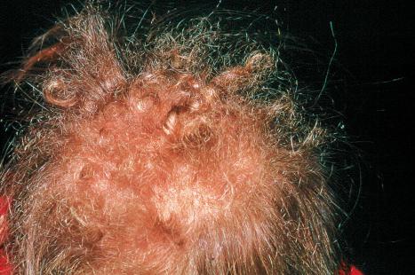 Fig. 31.1, Woolly hair nevus: the extremely curled hair on the top of the head contrasts with the normal straight hair on the side.