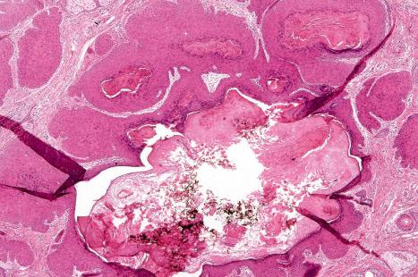 Fig. 31.12, Pilar sheath acanthoma: arising from the epidermis is a cystic invagination. Note the marked lobular epithelial proliferation.