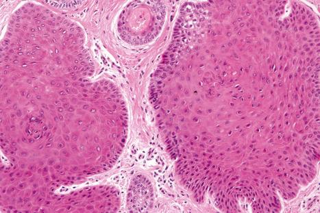 Fig. 31.13, Pilar sheath acanthoma: the tumor lobules are composed of outer root sheath squamous epithelium. There is no cytological atypia.