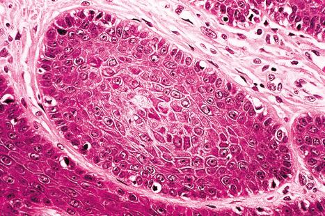 Fig. 31.14, Pilar sheath acanthoma: the epithelial lobules are surrounded by an eosinophilic hyaline basement membrane.