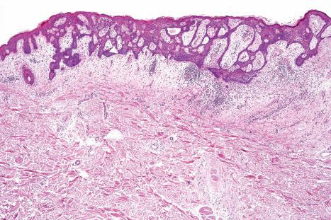 Fig. 31.15, Follicular infundibulum tumor: the tumor consists of anastomosing islands of basophilic cells showing multiple points of attachment to the overlying epithelium. The tumor is oriented parallel to the surface.