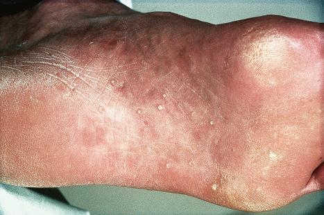 Fig. 31.20, Cowden disease: note the presence of multiple plantar keratoses.