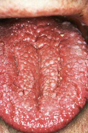 Fig. 31.21, Cowden disease: the innumerable shiny papules on this patient's tongue are characteristic.