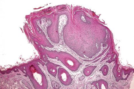 Fig. 31.23, Trichilemmoma: this facial lesion presented clinically as a small warty papule.