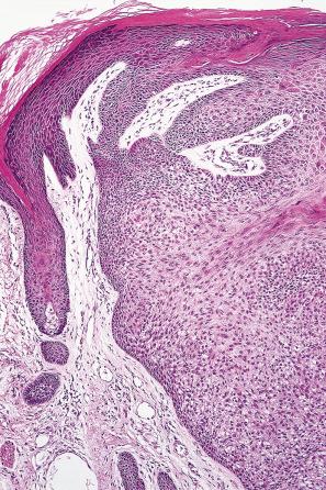 Fig. 31.24, Trichilemmoma: the tumor is composed of small, uniform cells showing cytoplasmic vacuolation.