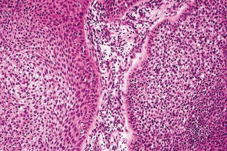 Fig. 31.26, Trichilemmoma: note the nuclear palisading.