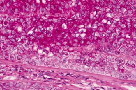 Fig. 31.27, Trichilemmoma: the PAS stain is strikingly positive.