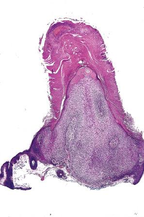 Fig. 31.29, Trichilemmoma: this lesion presented with a cutaneous horn.