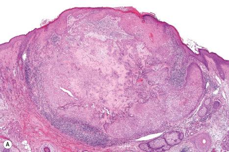 Fig. 31.30, Desmoplastic trichilemmoma: ( A ) note the epidermal origin. In the center of the lesion there is marked sclerosis; ( B ) the periphery of the tumor shows the typical features of trichilemmoma.