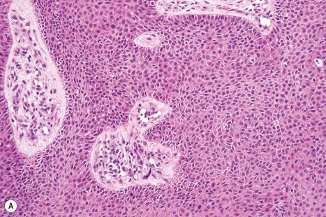 Fig. 31.31, Desmoplastic trichilemmoma: ( A ) high-power view; ( B ) note the admixture of epithelial strands and dense hyalinized collagen. This appearance is easy to mistake for a malignant tumor.