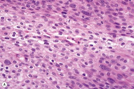 Fig. 31.33, Trichilemmal carcinoma: ( A ) there is clear cell change; ( B ) there is marked nuclear pleomorphism.