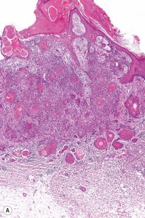 Fig. 31.36, ( A , B ) Trichilemmal carcinoma: this example shows an infiltrative growth pattern reminiscent of squamous cell carcinoma. There is widespread pilar-type keratinization.