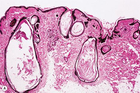 Fig. 31.4, Comedone nevus: ( A ) the lesion is characterized by both open and closed comedones; ( B ) shown in higher power.