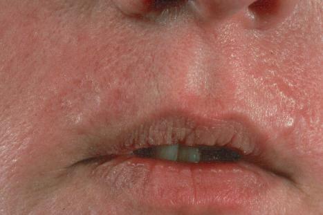 Fig. 31.5, Basaloid follicular hamartoma: note the pale infiltrated plaques involving the upper lip.