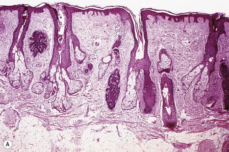 Fig. 31.7, Basaloid follicular hamartoma: ( A ) adjacent to each pilosebaceous unit is a hamartomatous lesion; ( B ) note the anastomosing strands of small basophilic cells and the spindle cell connective tissue stroma.