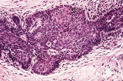 Fig. 31.8, Basaloid follicular hamartoma: note the peripheral nuclear palisading.