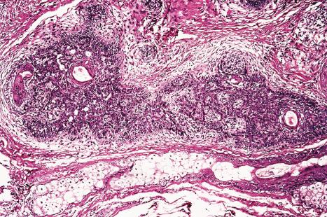 Fig. 31.9, Basaloid follicular hamartoma: in this example, the features are indistinguishable from those of a trichoepithelioma. Note the lacelike epithelial islands and the conspicuous stroma.