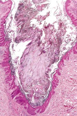 Fig. 31.10, Dilated pore: note the follicular dilatation and keratin plugging.