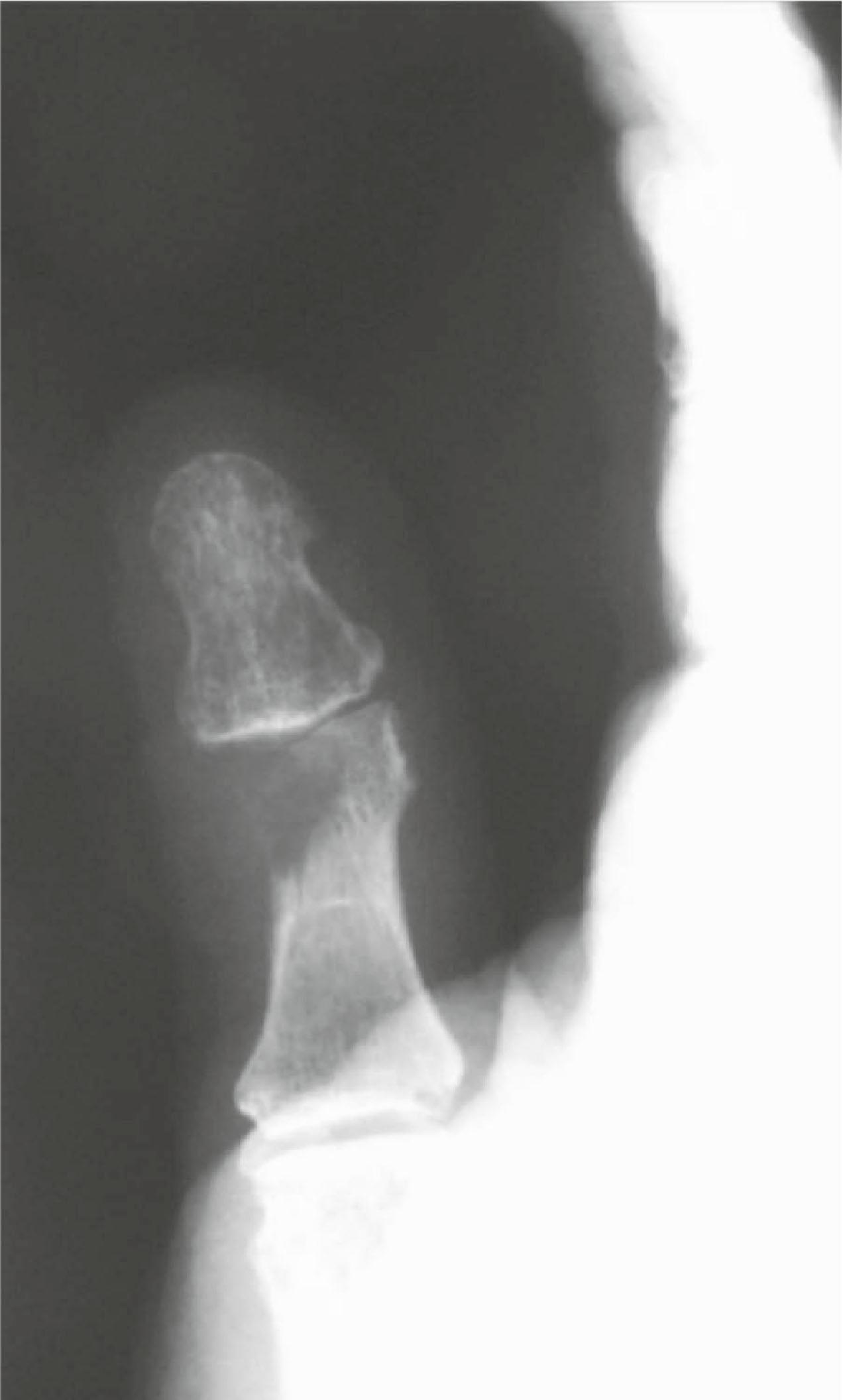 Figure 16.1, In this proximal phalanx lesion of the thumb a destroyed cortex potentially indicates a malignant process.