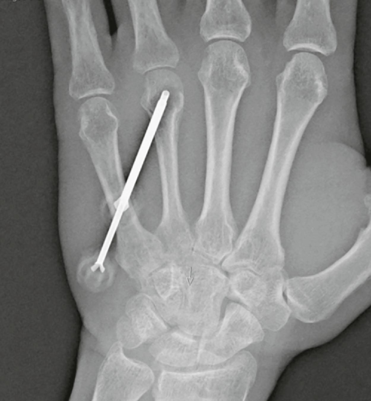 Figure 16.3, Anteroposterior view of fluoroscopic-assisted fourth metacarpal biopsy for suspected osteomyelitis.